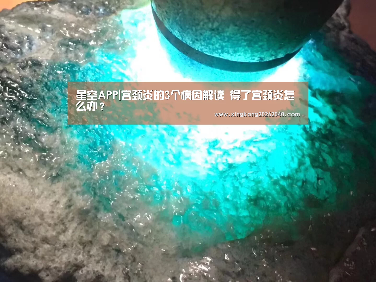 星空APP|宫颈炎的3个病因解读 得了宫颈炎怎么办?(图1) 星空百家乐